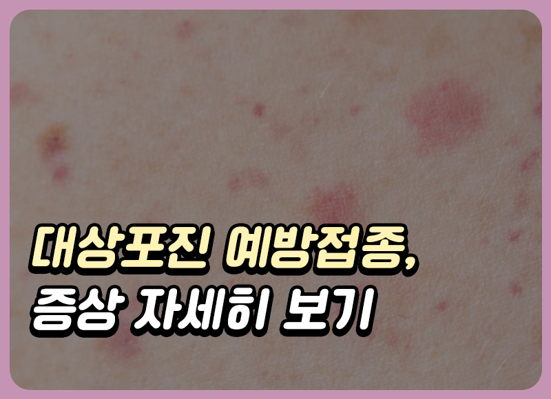 대상포진 증상과 예방접종 가격은?